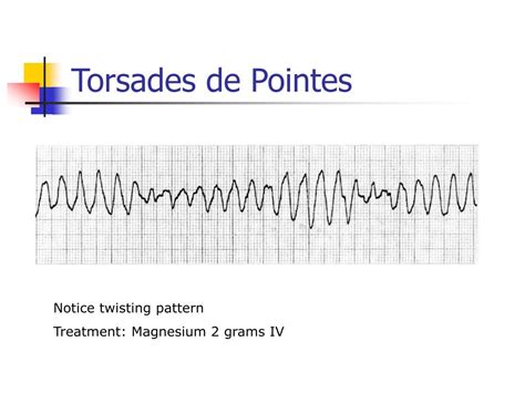 PPT - EKG Interpretation PowerPoint Presentation, free download - ID:263617