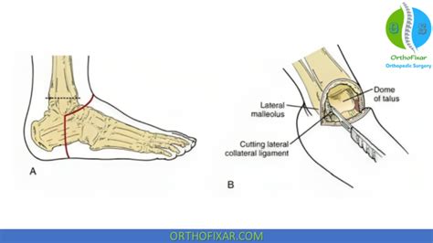 Syme Amputation & Prosthesis | OrthoFixar 2024