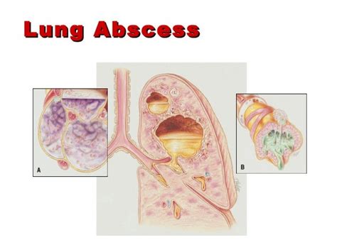 Suppurative lung diseases