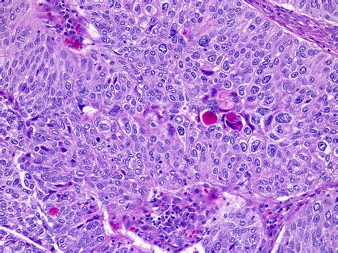 Pathology Outlines - Noninvasive papillary urothelial carcinoma high grade