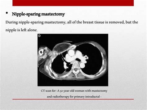 Mastectomy | PPT