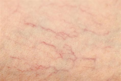 Causes and Prevention of Varicose and Spider Veins