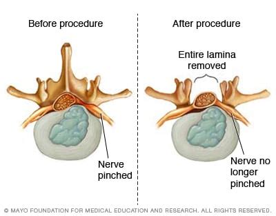 Lumbar Laminectomy | Sierra Neurosurgery Group