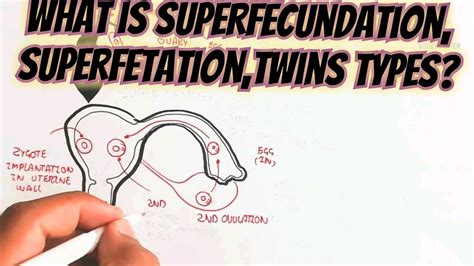 What Is Superfecundation, Superfetation,Twins Types ...