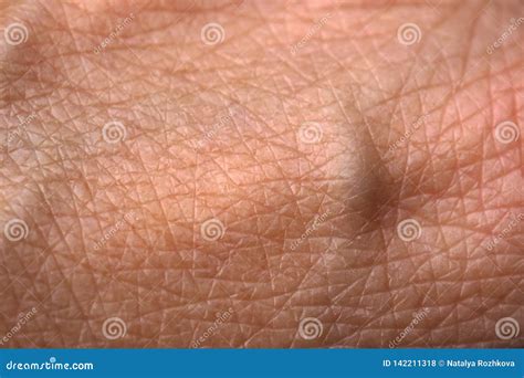 Hand Skin with Swollen Veins Stock Photo - Image of injury, body: 142211318