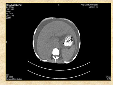 Protein Losing Enteropathy Diet Management For Hypothyroidism - clipsgala