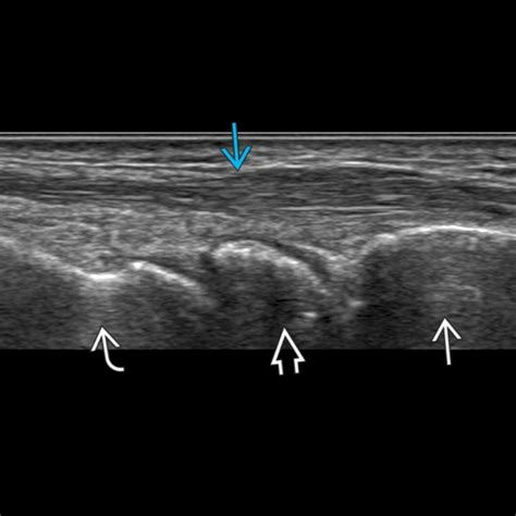 Wrist Ultrasound | Radiology Key