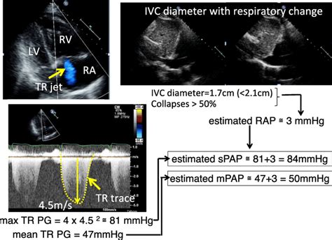 Evaluation of pulmonary artery pressure (PAP) by echocardiography. The... | Download High ...