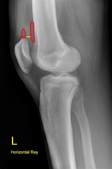 Knee X-rays - Don't Forget the Bubbles