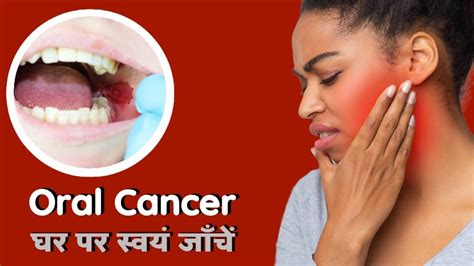 Oral Cancer Self Examination मुंह के कैंसर को घर पर स्वयं जांचे - YouTube