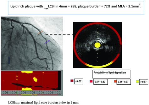 Representative image of near-infrared spectroscopy and intravascular ...