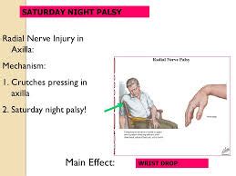 Wrist drop - #medical article #anatomy - LANKA STUDENTS