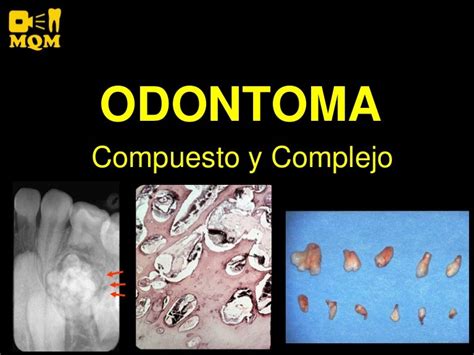 Odontoma Histology