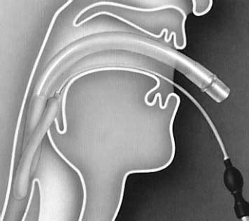 Demonstration of correct anatomical positioning of the laryngeal mask ...