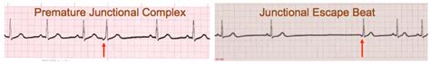 Premature Junctional Complex (PJC) and Junctional Escape Beats - EKG Lesson #314