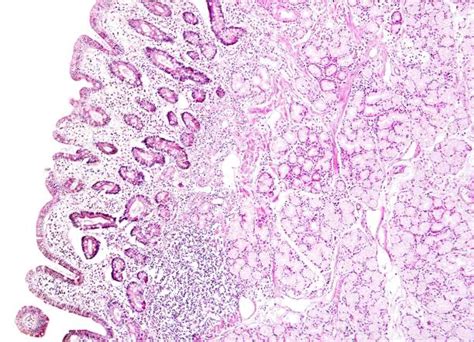 Histology of human tissue, show gastric mucosa intestinal metaplasia as ...