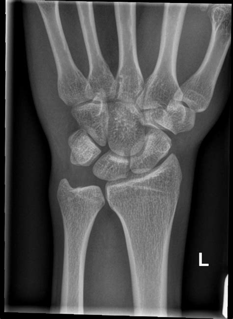 Docs and Radiologists does this look like a fracture to you? - AR15.COM