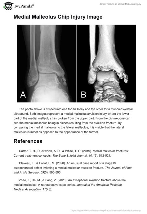 Chip Fracture as Medial Malleolus Injury - 700 Words | Research Paper Example