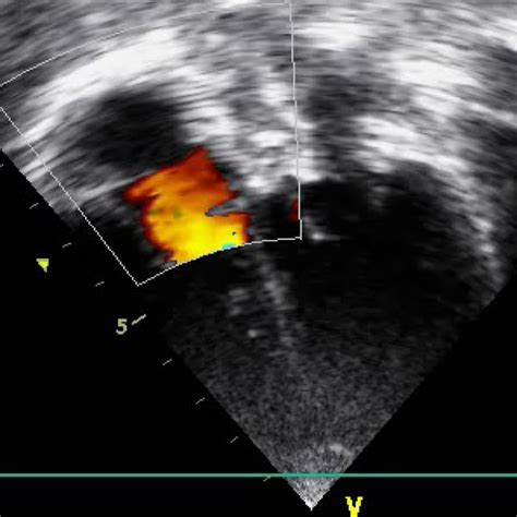 Postprocedure echocardiography showing atrial septal defect device in ...