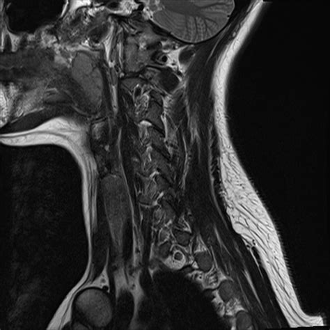 Normal trauma cervical spine MRI | Radiology Case | Radiopaedia.org