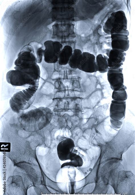 barium enema image front view is a rectal injection of barium contrast. This coats the lining of ...