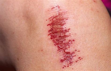 Wounds - Scrape | Stage Makeup | Pinterest