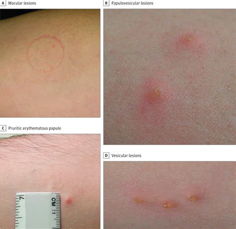 Cutaneous Lesions Due to Bites by Larval Amblyomma americanum Ticks ...