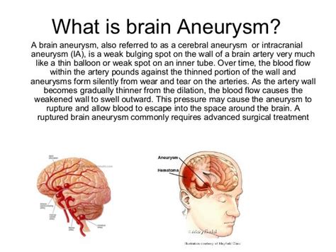 Brain aneurysms in general