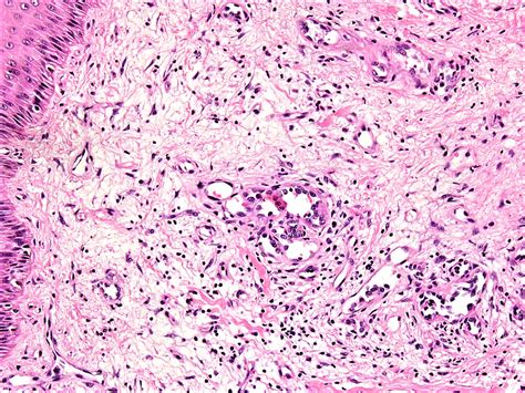 Skin Hemangioma Histology