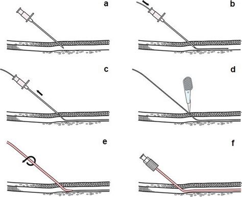 A step by step scheme of the Seldinger technique. The needle puncturing ...