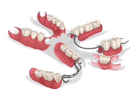 Partial Dentures Types