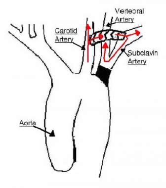 Subclavian Artery Thrombosis Treatment & Management: Approach Considerations, Medical Therapy ...