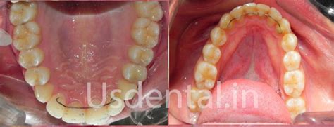 Before and After Misalignment Teeth Alignment – Case of the Month | US ...