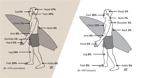 SURF SURVIVAL: KNOW YOUR INJURIES | SURFLINE.COM