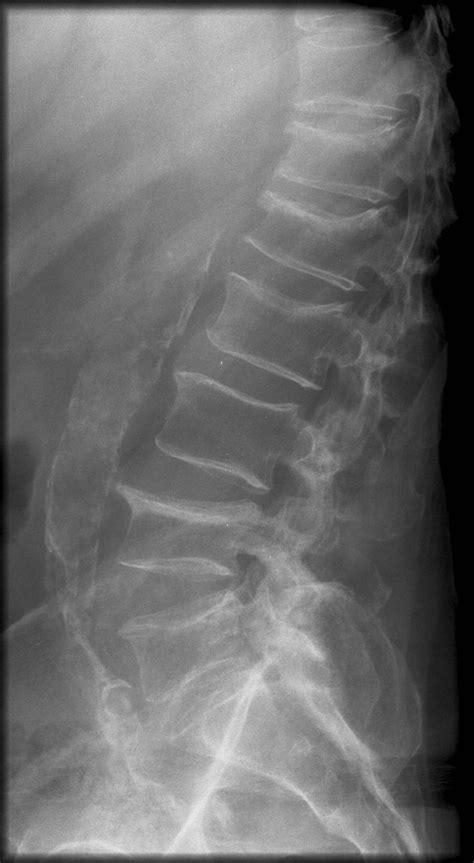 Osteoporosis (Suspected)