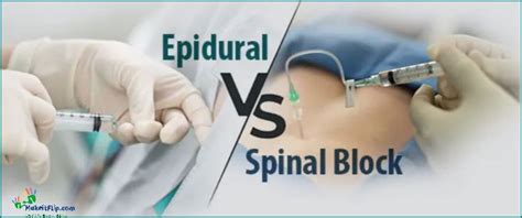 Epidural vs Spinal Understanding the Differences and Benefits [Updated July 2024] - Makeitflip.com