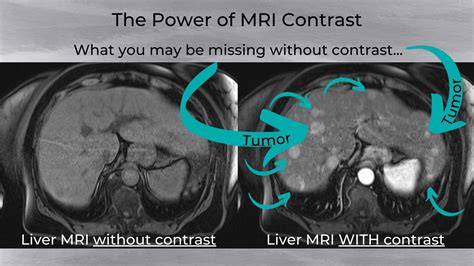 Can I Refuse Contrast Dye for MRI Scans?