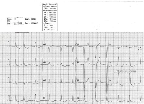 Left Bundle Branch Block And Left Ventricular Hypertrophy Ecg | Porn Sex Picture