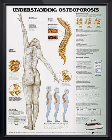 Osteoporosis anatomy poster shows anterior, lateral and posterior views of the skeletal system ...