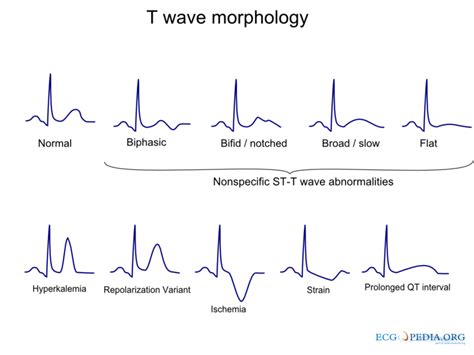 T Wave Meaning