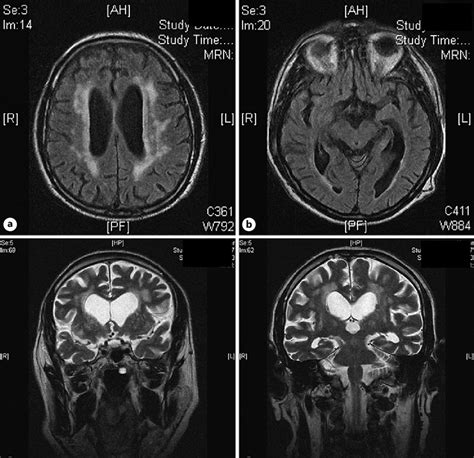 Head MRI scan illustrating vascular encephalopathy and global brain... | Download Scientific Diagram