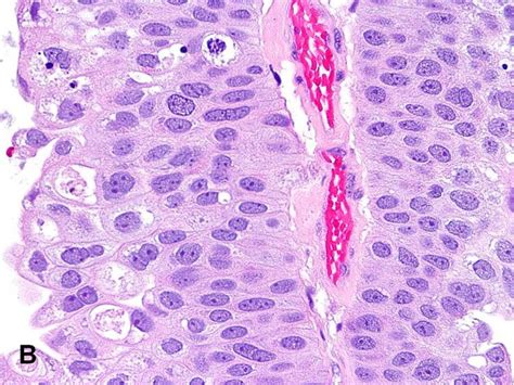 American Urological Association - Papillary Urothelial Carcinoma, High Grade | Grade, High ...