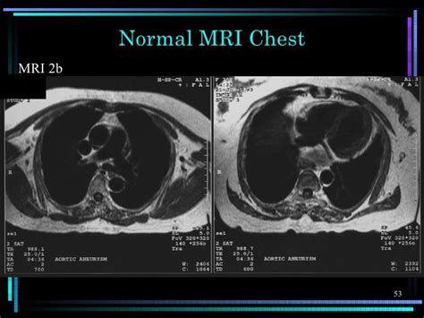 Mri Chest Anatomy