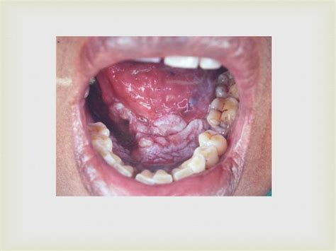 Tumor of oral cavity