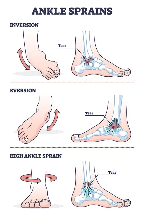 Ankle Sprains Situations With Inversion And Eversion Injury Outl - NTFANTFA