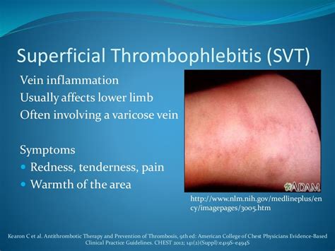 Superficial vein thrombosis