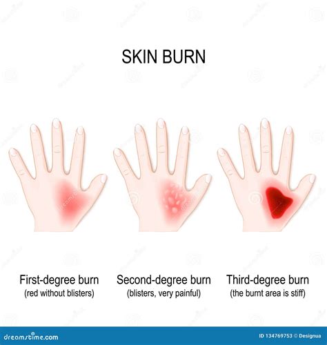 Degree Burns of Skin. Step of Burn Stock Vector - Illustration of poster, classification: 134769753