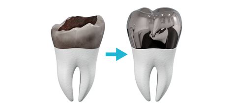 What is the Hall Crown Technique? | Coastal Dental Care