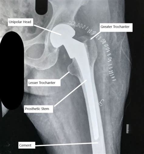 Partial Hip Replacement Vs Total Hip Replacement | Complete Orthopedics ...