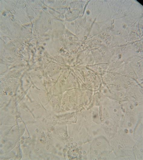 Fungi in the urine test (GUE) Medical Laboratory Scientist, Fungi ...